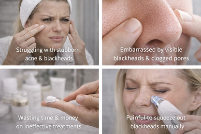 CLEARSKIN™ DeepClean Pro – Professional Blackhead & Acne Pore Vacuum for Clear, Smooth & Glowing Skin